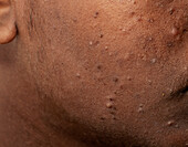 Acne vulgaris