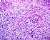 Pleomorphic adenoma in submaxillary gland, light micrograph