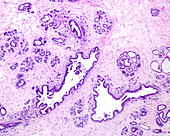 Breast adenosis, light micrograph