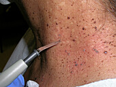 Electrosurgery to remove dermatosis papulosa nigra papules