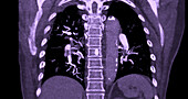 Pulmonary embolism, CT scan