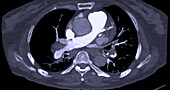 Pulmonary embolism, CT scan