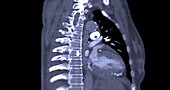 Pulmonary embolism, CT scan