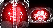 Pulmonary embolism, CT scans