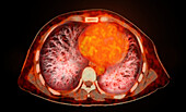 Healthy chest, CT-PET scan