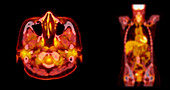 Healthy head and chest, CT-PET scan