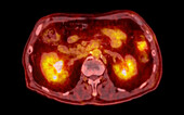 Normal abdomen, CT-PET scan