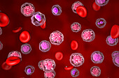 Acute lymphoblastic leukemia, illustration