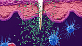 Bacteria entering the body via a needle wound, illustration