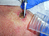 Superficial basal cell carcinoma removal