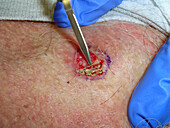 Superficial basal cell carcinoma removal