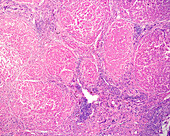 Cirrhosis, light micrograph