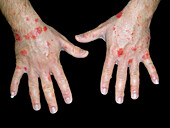 Dyshidrotic and nummular eczema