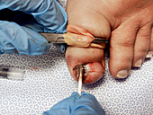 Ingrown toenail surgery