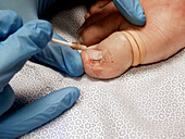 Ingrown toenail surgery