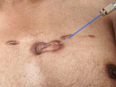 Cryosurgery of keloid scars