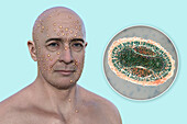Man with rash from pox virus infection, illustration
