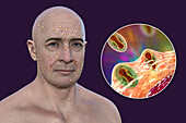 Man with rash from pox virus infection, illustration
