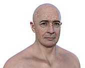 Man with rash from pox virus infection, illustration