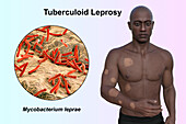 Tuberculoid leprosy, illustration