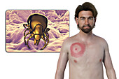 Man with erythema migrans from Lyme disease, illustration