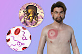 Man with erythema migrans from Lyme disease, illustration