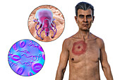 Man with erythema migrans from Lyme disease, illustration