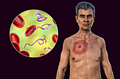 Man with erythema migrans from Lyme disease, illustration