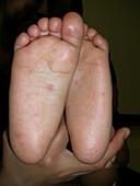 Hand foot and mouth disease