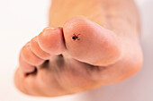 American dog tick on a person's toe