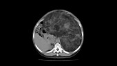 Abdomen liposarcoma, CT scan