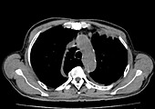 Azygos lobe, CT scan