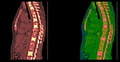 Bone cancer, CT scan