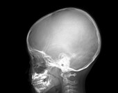 Enlarged adenoids, X-ray