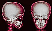 Normal skull, X-ray