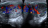 Orchitis testicle infection, ultrasound scan