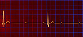 Complete heart block electrocardiogram, illustration