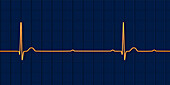 Complete heart block electrocardiogram, illustration