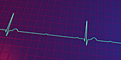 Complete heart block electrocardiogram, illustration