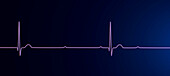 Complete heart block electrocardiogram, illustration