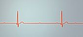 Complete heart block electrocardiogram, illustration