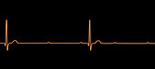 Complete heart block electrocardiogram, illustration