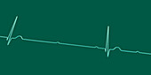 Complete heart block electrocardiogram, illustration