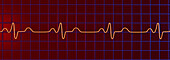 Bundle branch block electrocardiogram, illustration