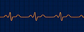 Bundle branch block electrocardiogram, illustration