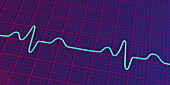 Bundle branch block electrocardiogram, illustration