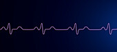 Bundle branch block electrocardiogram, illustration