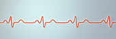 Bundle branch block electrocardiogram, illustration