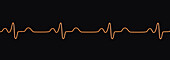 Bundle branch block electrocardiogram, illustration