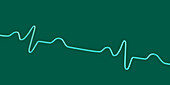 Bundle branch block electrocardiogram, illustration